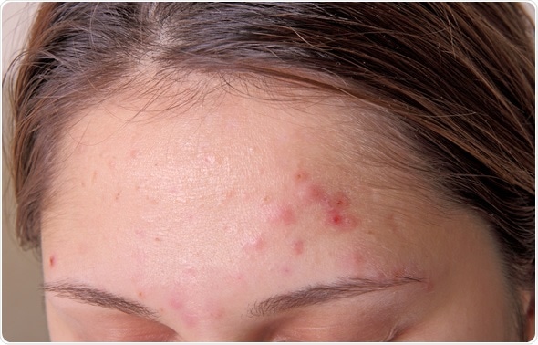 Acne on forehead. Image Copyright: TRIG / Shutterstock